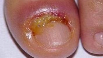 灰指甲的症状表现详细是哪些 