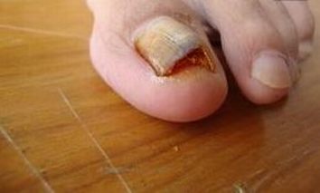 灰指甲的症状表现