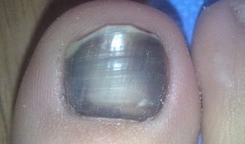 灰指甲的早期的症状 