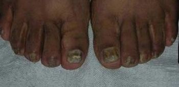 灰指甲的早期的症状怎么诊断