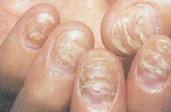 灰指甲会对人体形成什么危害 
