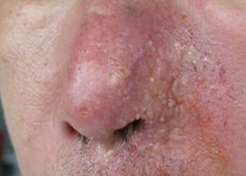 酒渣鼻的病因主要都包含什么呢