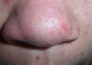 皮肤医生有关酒糟鼻的防范妙招进行研讨