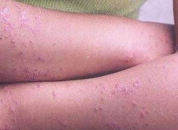皮肤异痒是多种疾病的预兆