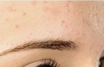 皮肤异痒主要病因有什么