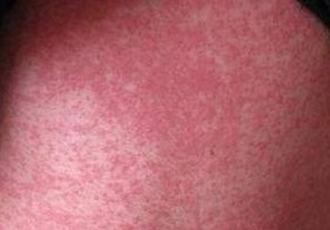 致使皮肤异痒症的发病病因有什么