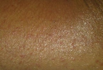 皮肤异痒常是多种疾病的信号