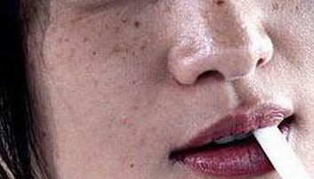 除掉雀斑如何治疗好