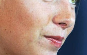 致使雀斑形成的有什么原因