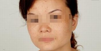 雀斑在夏天所存在的种种危害