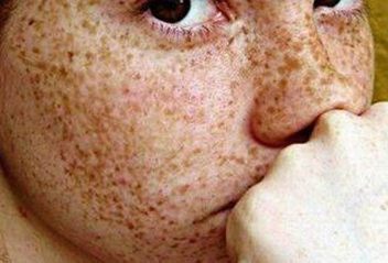雀斑原来是如此来的