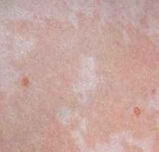 花斑癣皮肤病能不能传染