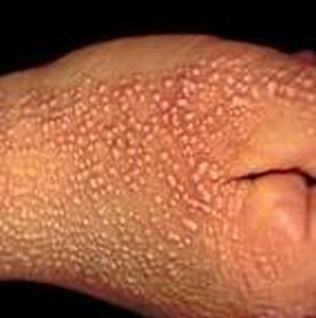 花斑癣是皮肤病吗