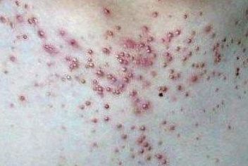 痤疮的治疗规定