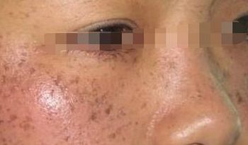 黄褐斑在夏季其症状有哪些