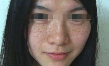 黄褐斑会给人带来什么伤害