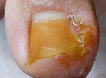 甲沟炎到底患什么病