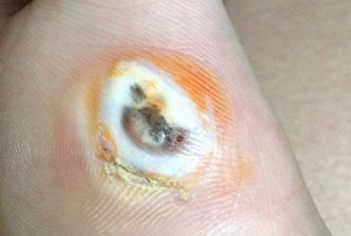 脚底鸡眼怎样预防 