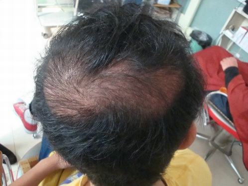 斑秃患者不治疗后果