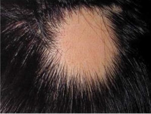 引发斑秃的病因有什么呢