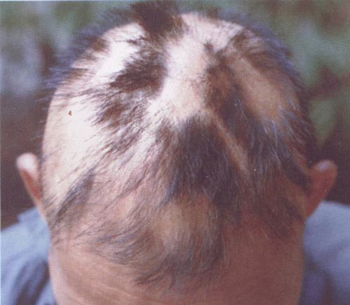 影响斑秃诱发的因素