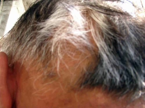 预防斑秃的食疗办法有什么
