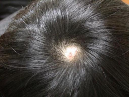 斑秃患者平时该如何护理