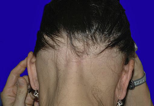斑秃患者应注意的日常护发细节