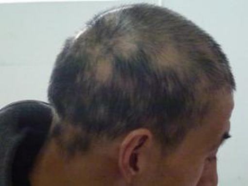 斑秃患者在生活中要注意什么