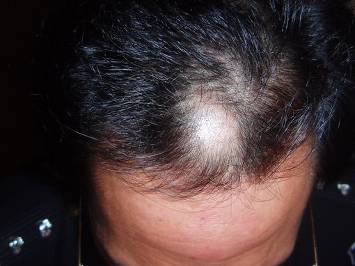 得了斑秃可能会引发什么常见的症状
