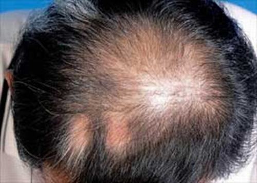 斑秃的发病原因以及护理方法