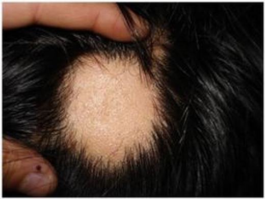 警惕斑秃引起的并发症