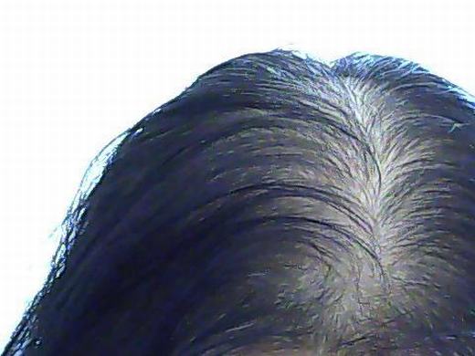 男性斑秃会出现哪些典型的症状