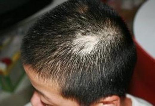 小儿斑秃的原因是什么呢