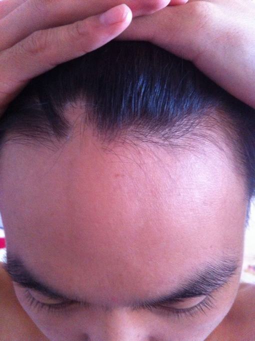 斑秃患者必须知道的护理事项