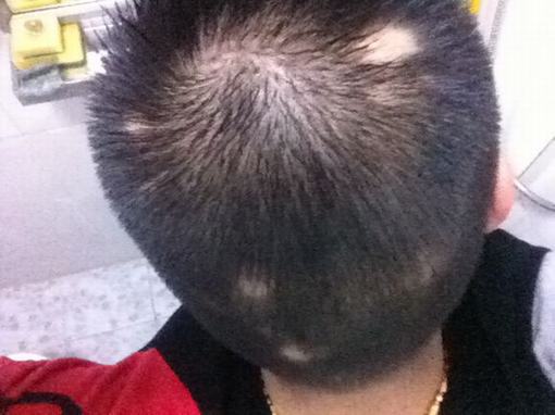 斑秃患者生活中要注意什么