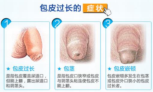 包皮过长有什么影响