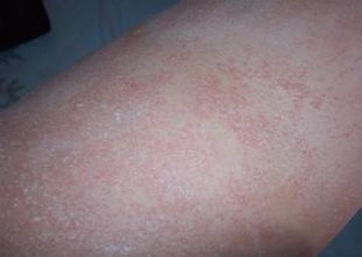 临床上依据什么来诊断口腔扁平苔藓