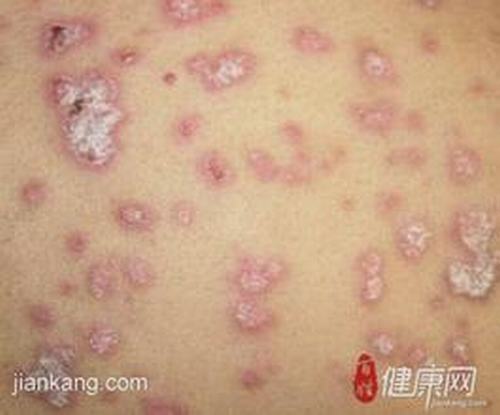 专家介绍扁平苔藓的饮食调理