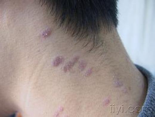 扁平苔藓预防有什么方法