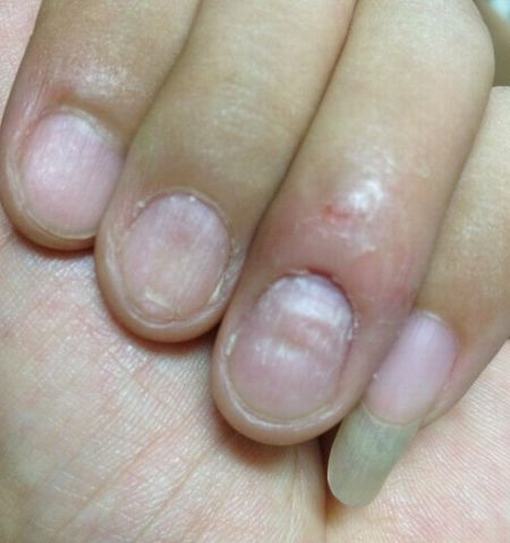 扁平苔癣的5种有效治疗方法