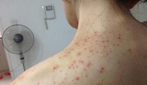病毒性软疣怎么治疗