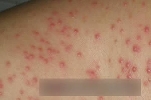 传染性软疣的治疗偏方