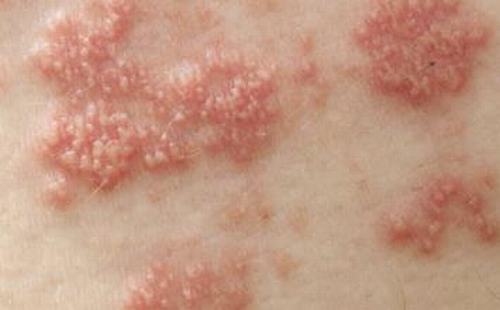 患者提问：带状疱疹的危害有哪些