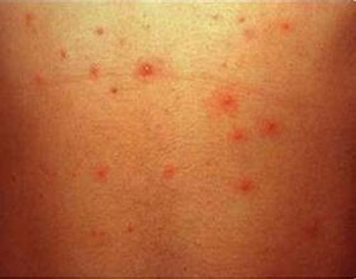认识7种特殊型带状疱疹