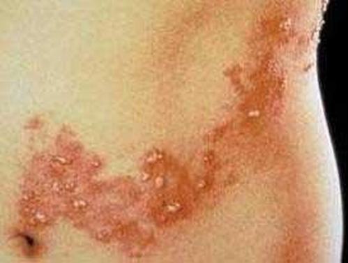 水痘和带状疱疹差异是什么