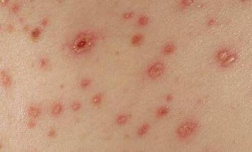 带状疱疹发病时有哪些表现