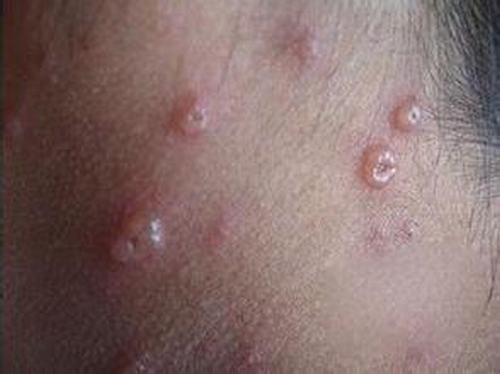 带状疱疹症状的常见表现有哪些
