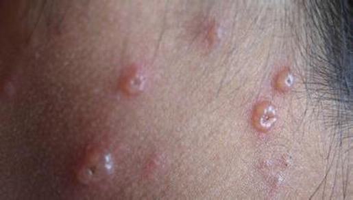 带状疱疹形成的原因有哪些