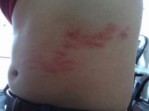 带状疱疹患者护理须知
